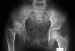 anneau pelvien podologie, proformed formations médicales anneau pelvien podologie, proformed formations médicales